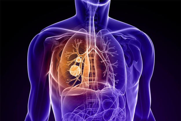 Akciğer Kanseri İle İlgili Detaylı Bilgi