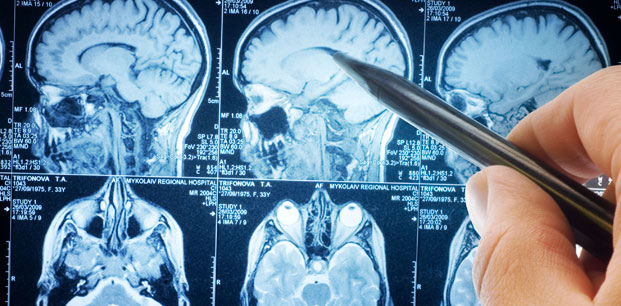 Beyin MR’ında Görülen Lekeler Tehlikeli midir?